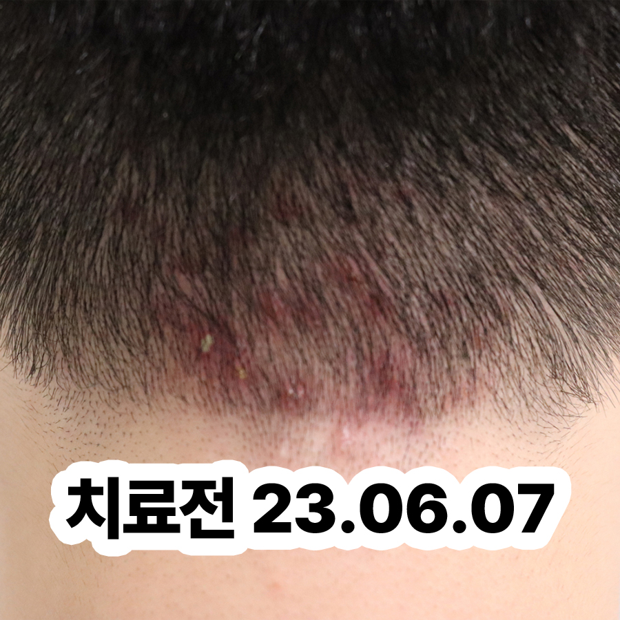 분당 지루성피부염한의원추천 관련 이미지 2