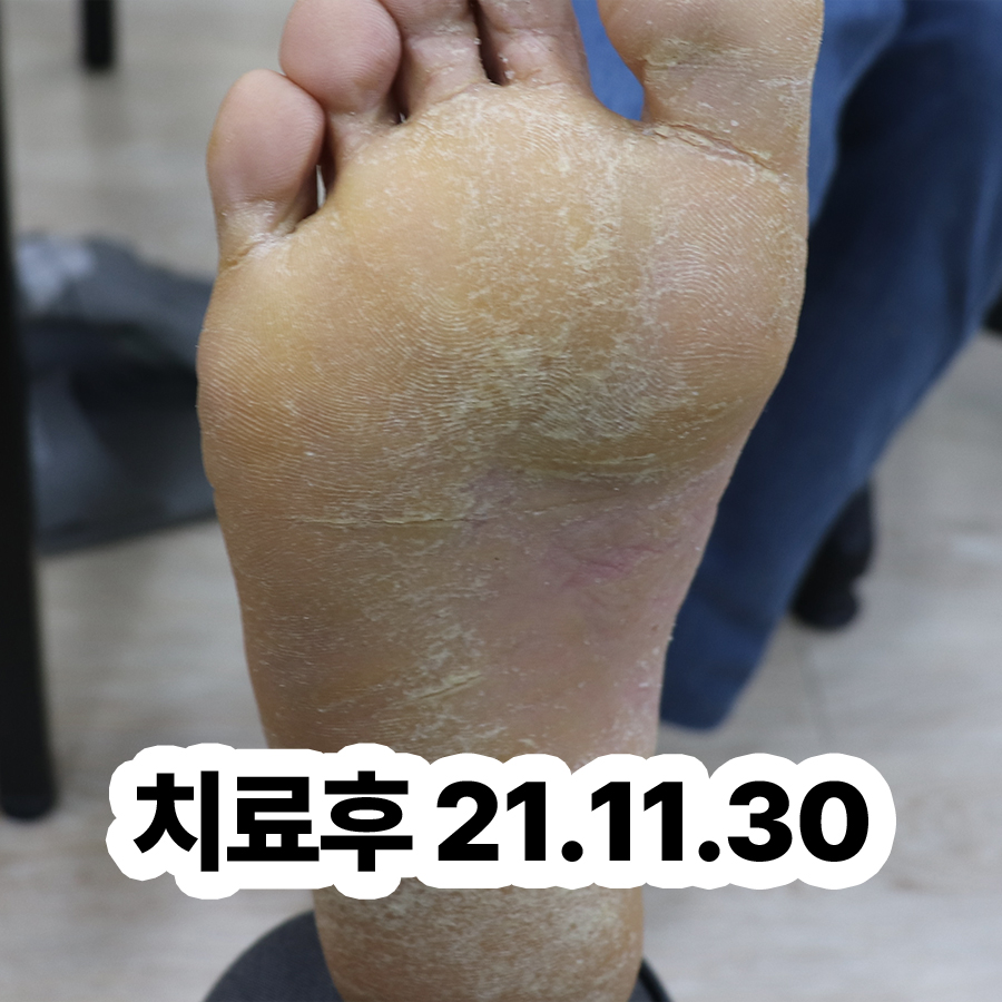 분당 피부건선치료법 관련 이미지 3