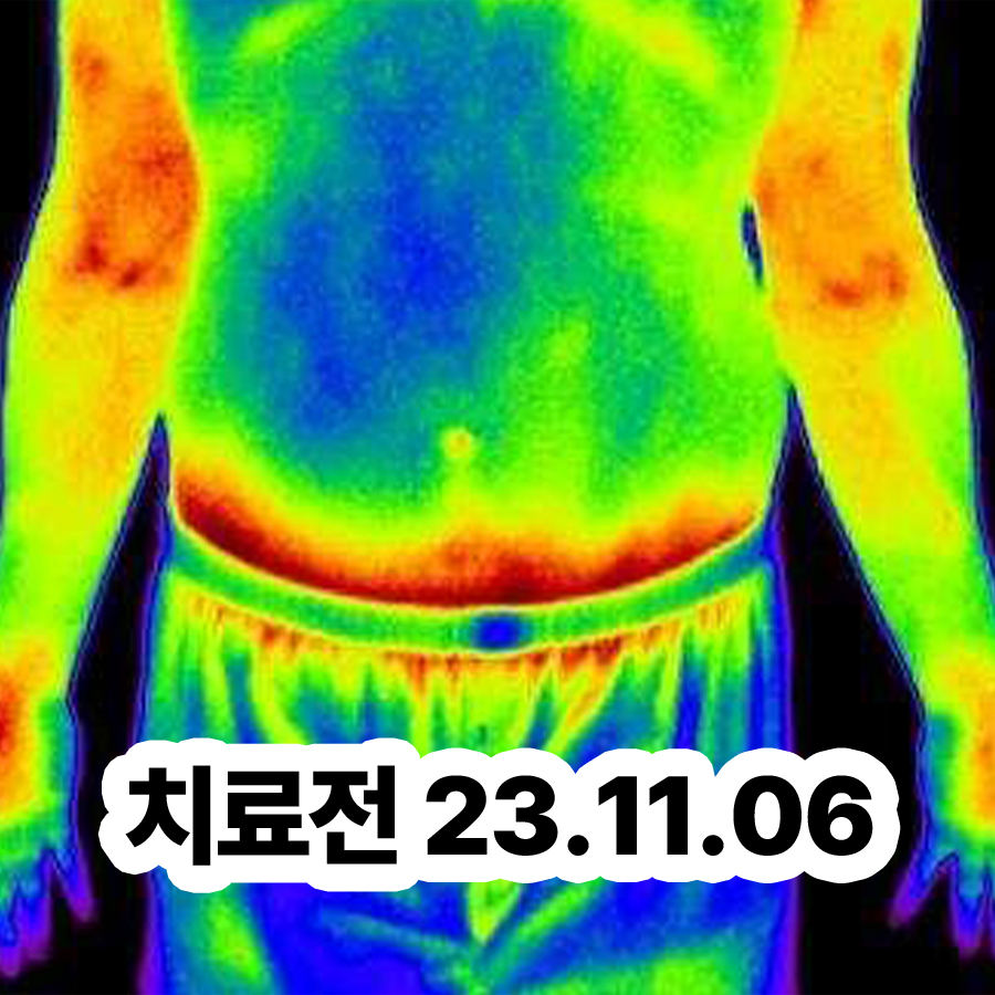 분당 손 다한증 치료 병원 관련 이미지 2