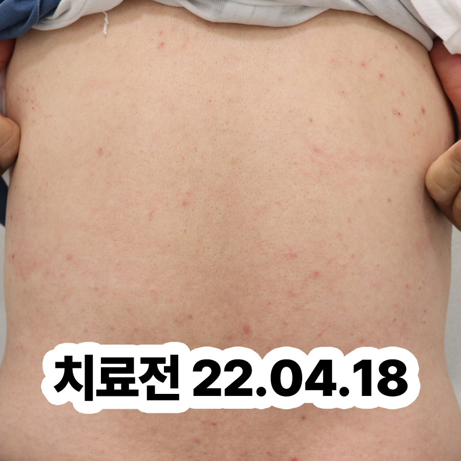 분당 두드러기한약 관련 이미지 2