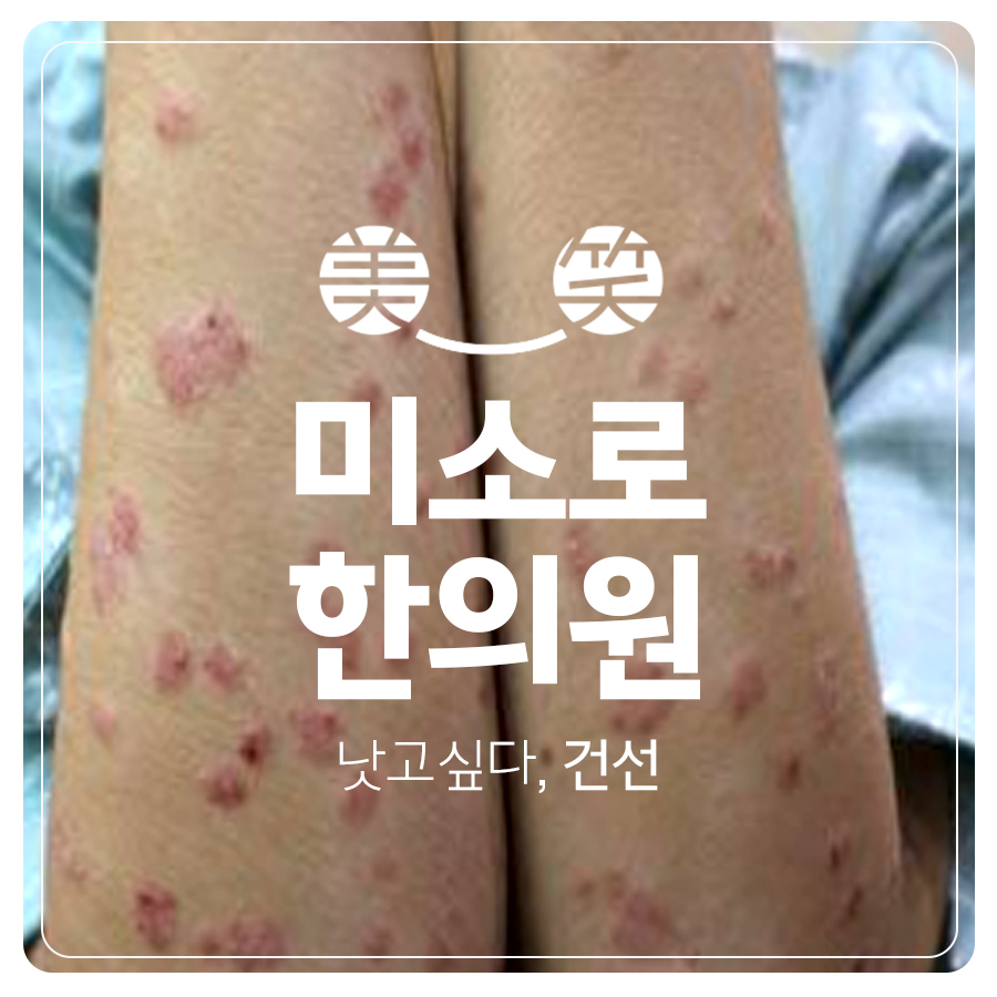 분당 건선 보습제 추천 관련 이미지 1