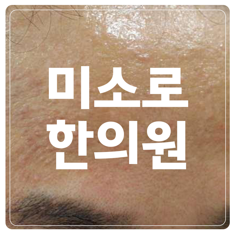 이천 발바닥 사마귀 수술 후기 관련 이미지 1