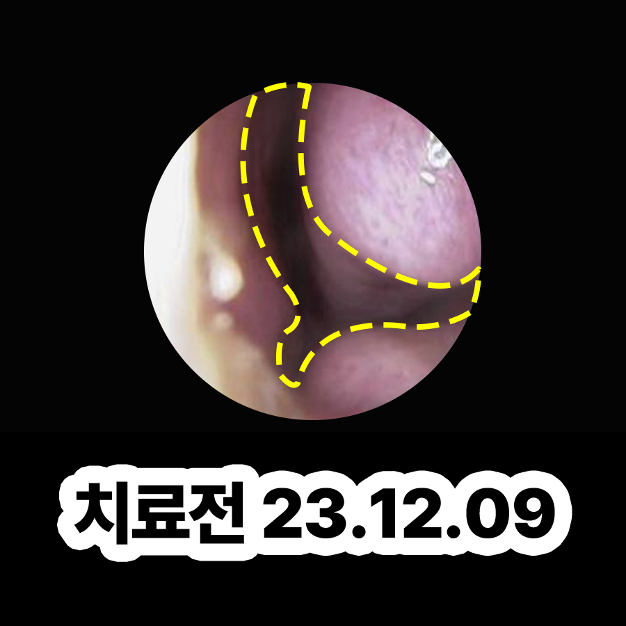 여주 축농증 증상 냄새 관련 이미지 2