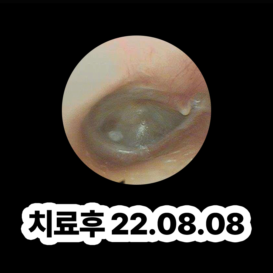 분당 소아 중이염 관련 이미지 3