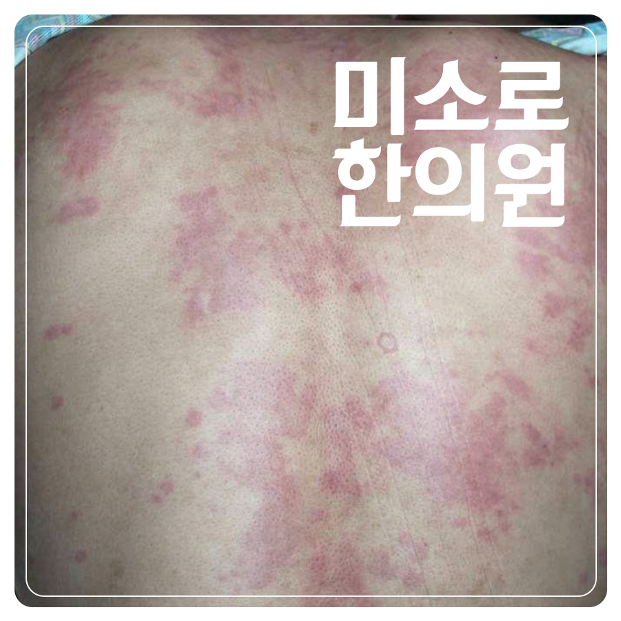 위례 피부묘기증 한의원 관련 이미지 1