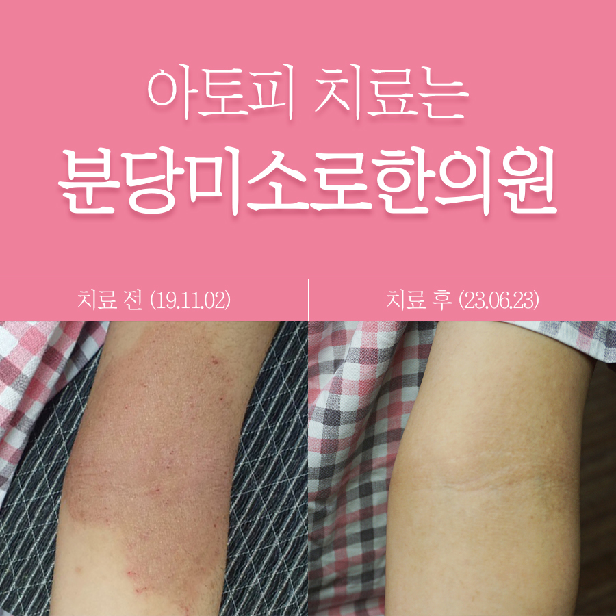 이천 아토피한방치료 관련 이미지 1