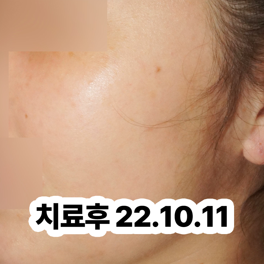 분당 지루성피부염한의원추천 관련 이미지 3