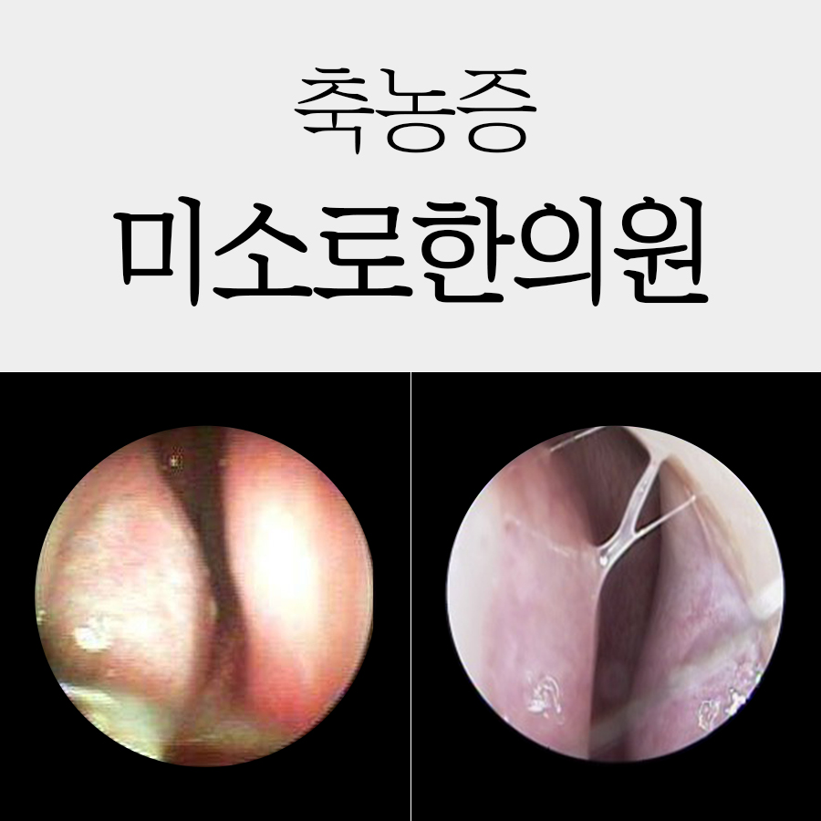 배방 진균성 부비동염 한의원 관련 이미지 1