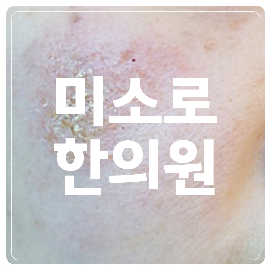 매탄동 화폐상 습진 원인 관련 이미지 1