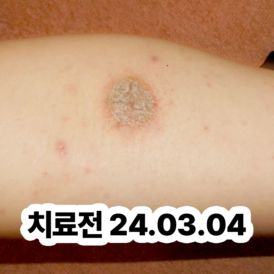 분당 화폐성 습진 치료방법 관련 이미지 2