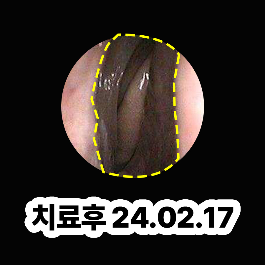 분당 한의원 비염 치료 효과 관련 이미지 3