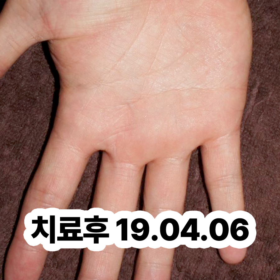 분당 한포진 약 관련 이미지 3