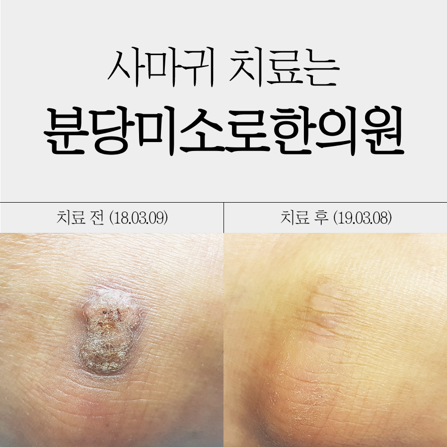 이천 사마귀치료 한의원 가격 관련 이미지 1