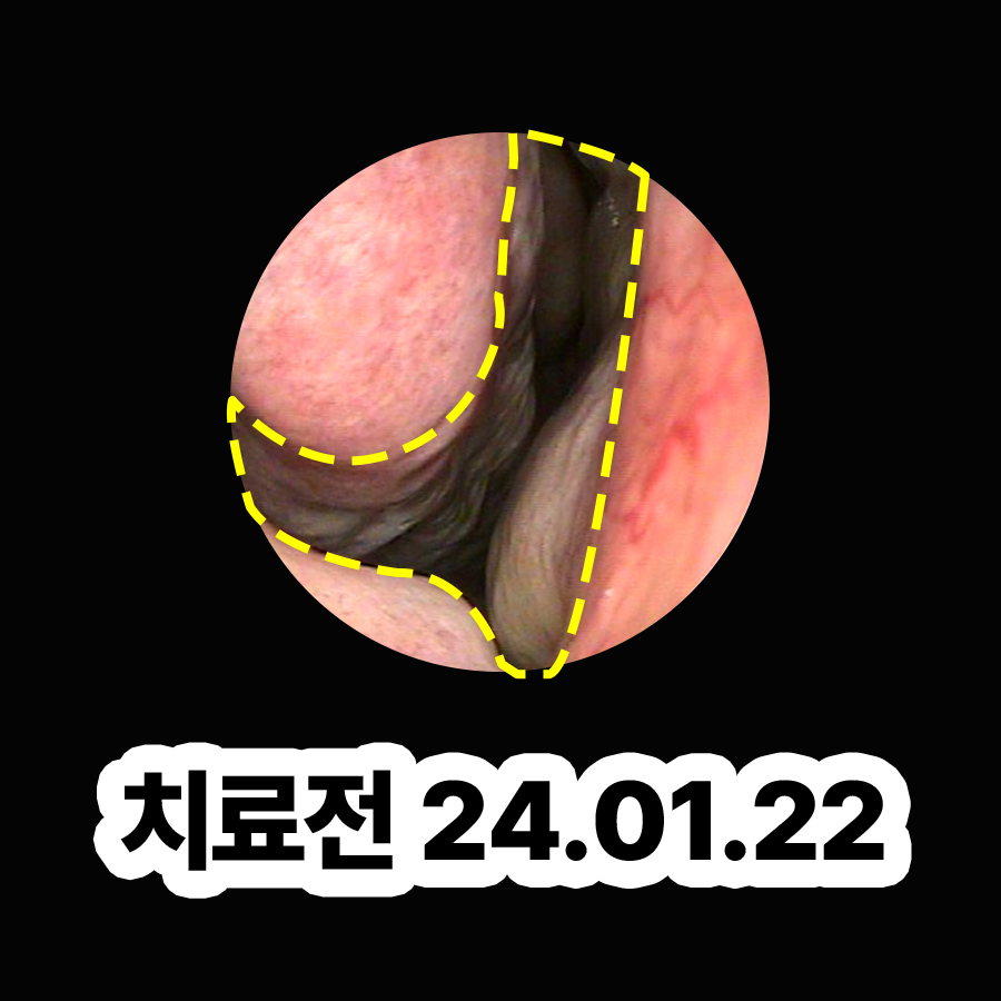 위례 비염수술잘하는병원 관련 이미지 2