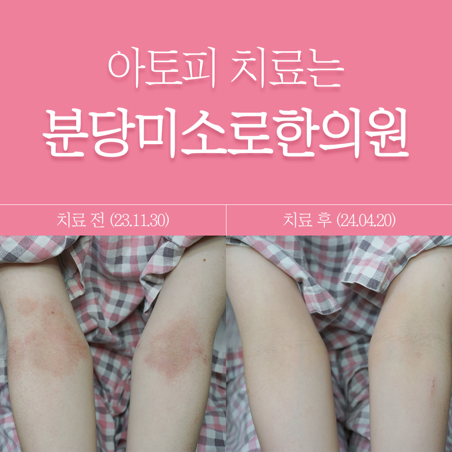 분당 아토피 한의원 관련 이미지 1