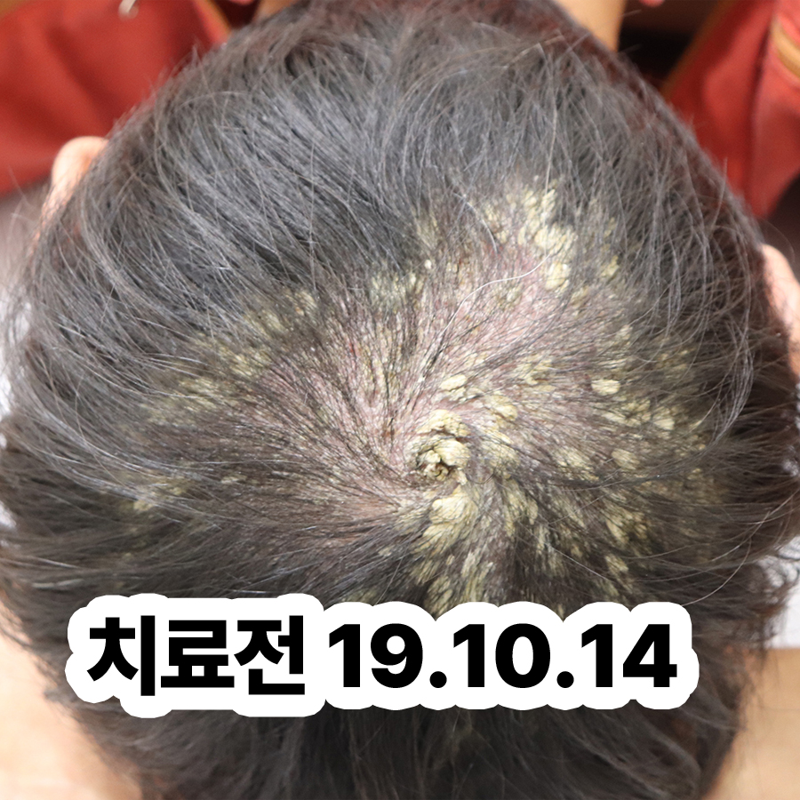 성남 두피 건선 치료 피부과 관련 이미지 2