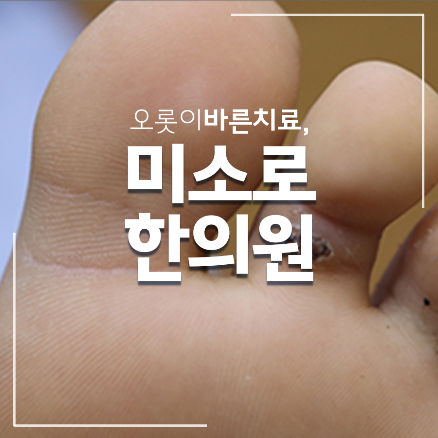 분당 편평사마귀 재발 방지 관련 이미지 1