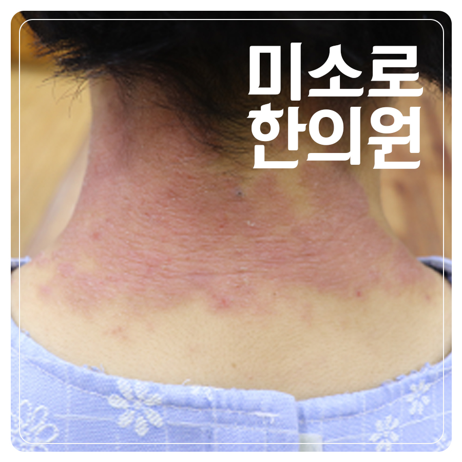 분당 아토피 한방치료 효과 관련 이미지 1