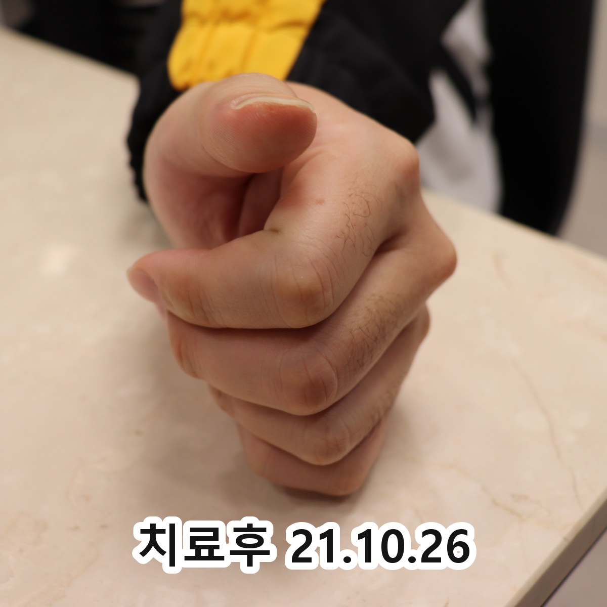 성남 얼굴 사마귀 치료연고 관련 이미지 3
