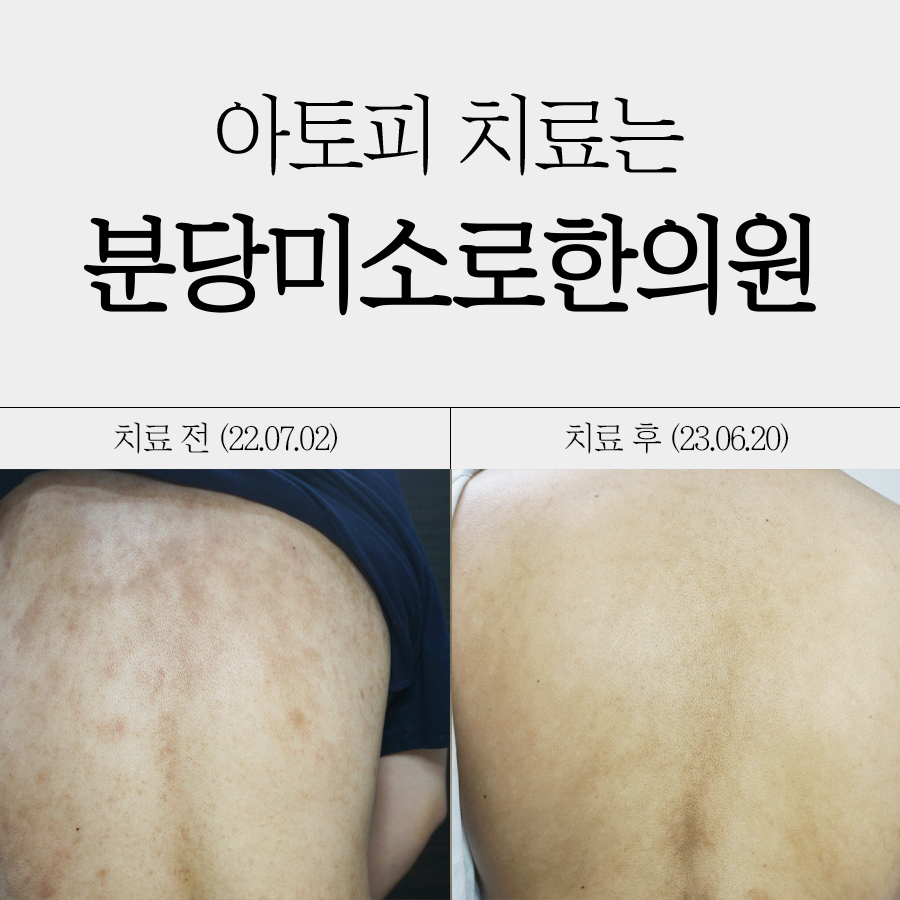 여주 아토피 치료 병원 관련 이미지 1