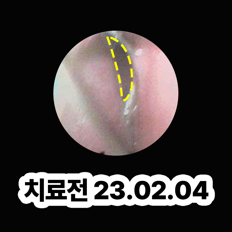 분당 축농증증세 관련 이미지 2