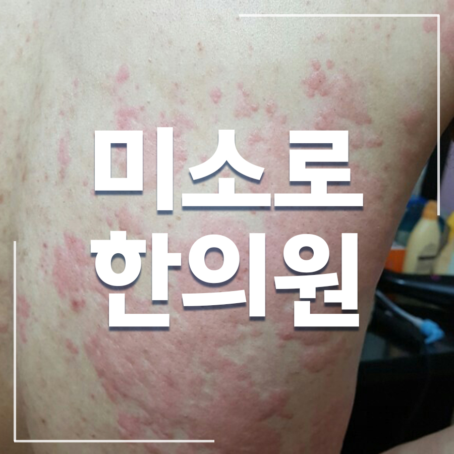 청당동 피부묘기증 관련 이미지 1