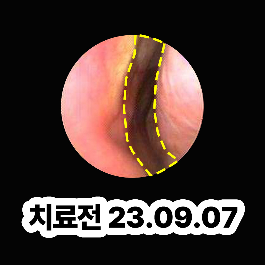 판교 비염콧물빼기 한의원 관련 이미지 2