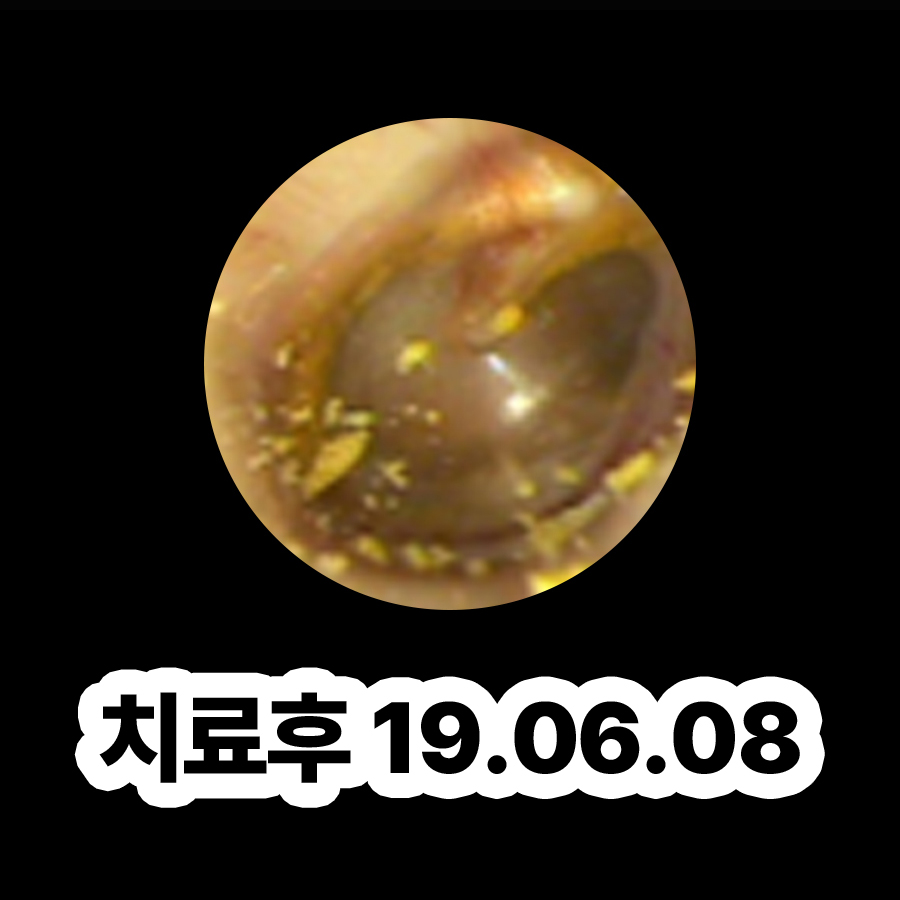 분당 만성 중이염 치료 기간 관련 이미지 3