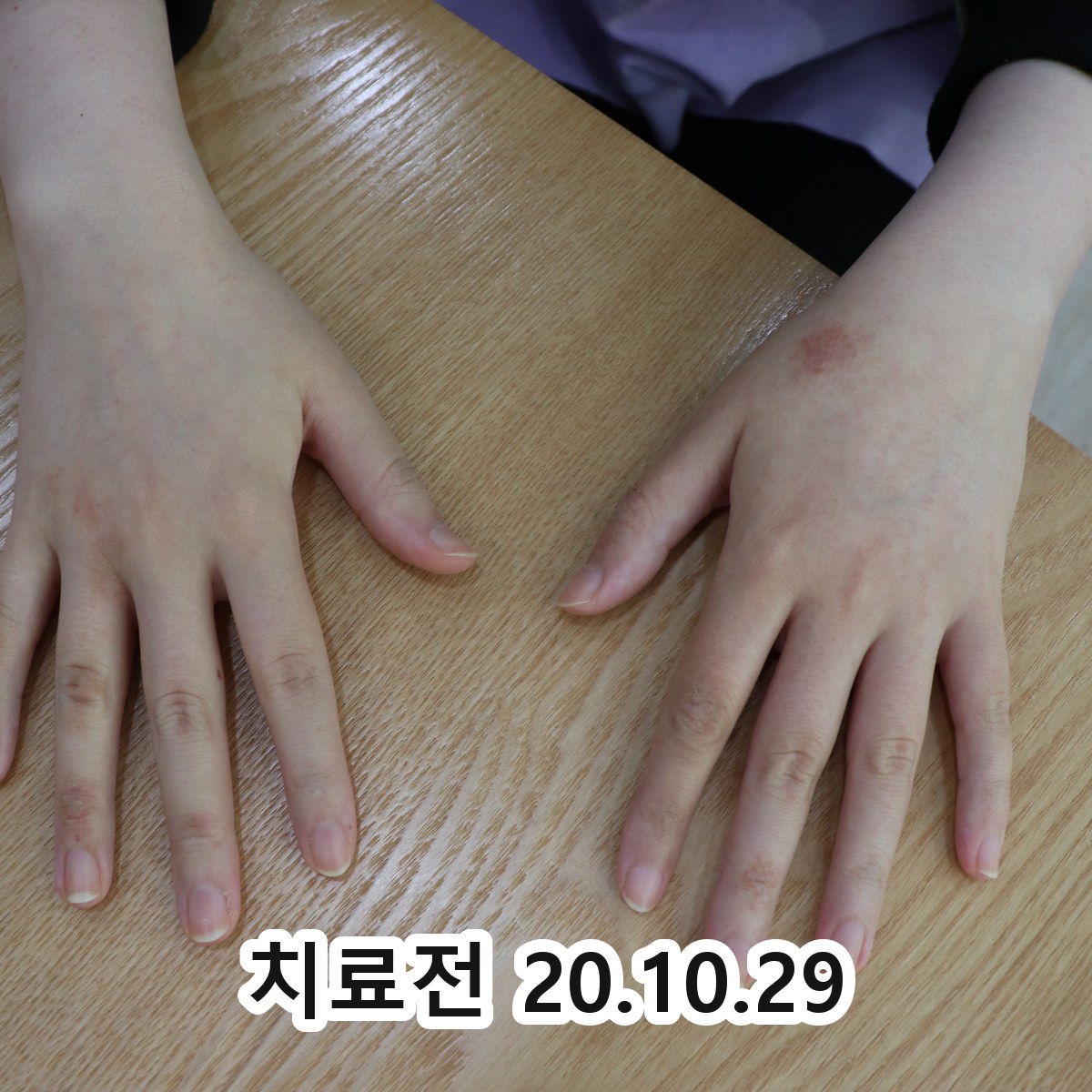 고덕 한포진 원인 관련 이미지 2