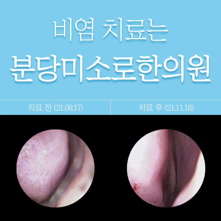 분당알레르기성비염한의원 관련 이미지 1