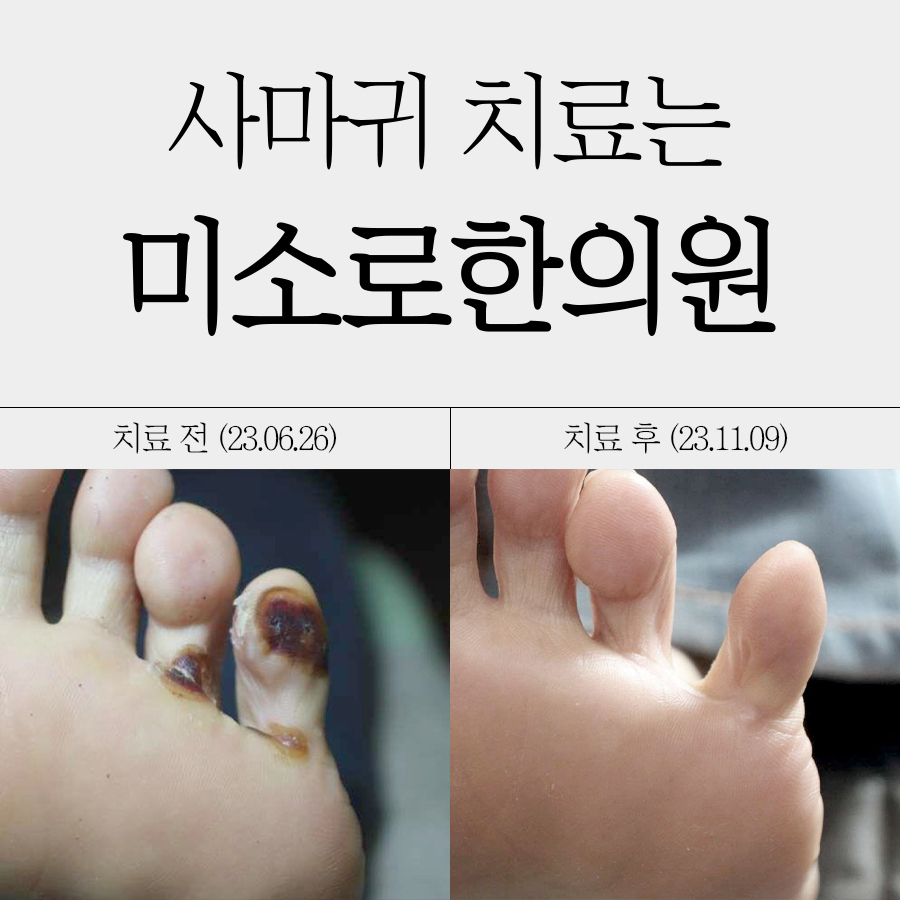 분당 발바닥 사마귀 병원 관련 이미지 1