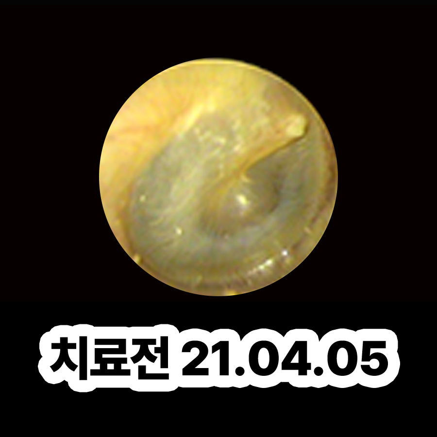 이천 중이염 원인 목욕 관련 이미지 2