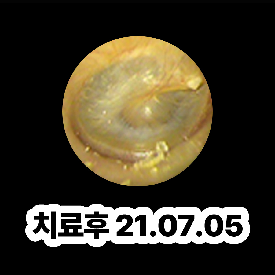 이천 중이염 원인 목욕 관련 이미지 3