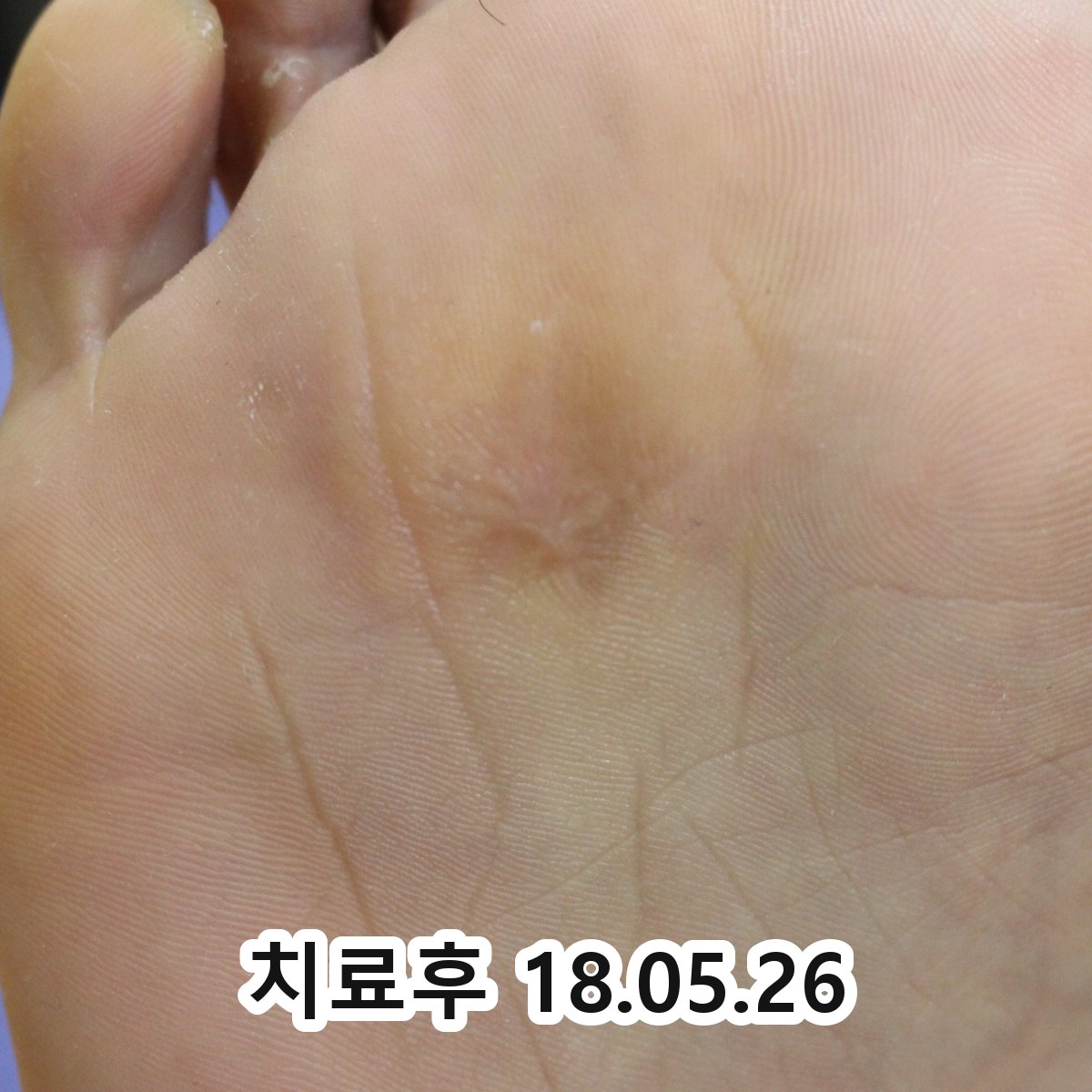 안중 편평사마귀프로폴리스 관련 이미지 3