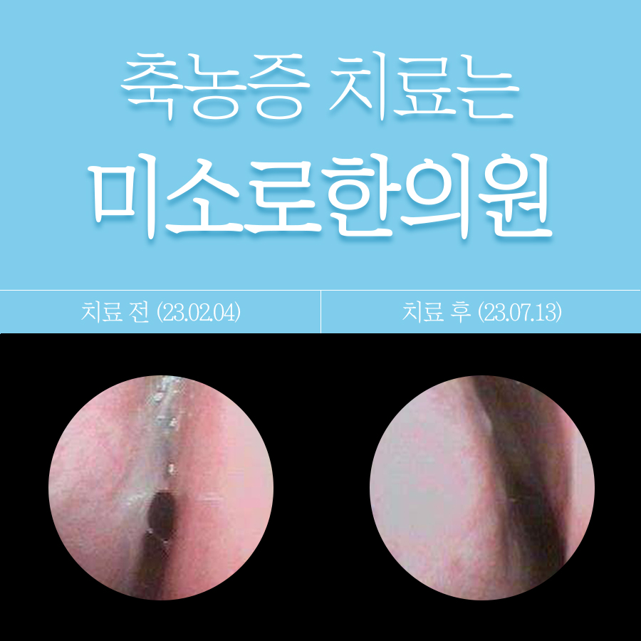 만성 축농증 치료 방법 관련 이미지 1