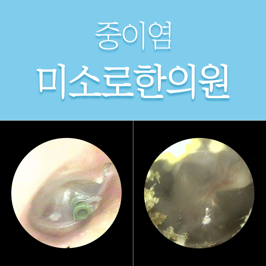 성남 삼출성 중이염 증상 관련 이미지 1