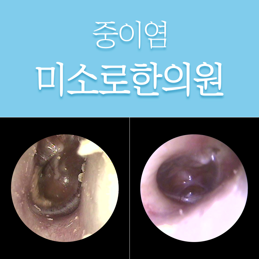 위례 삼출성 중이염 치료법 관련 이미지 1
