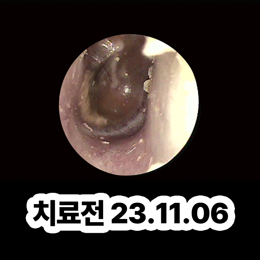 판교 중이염 약국약 관련 이미지 2