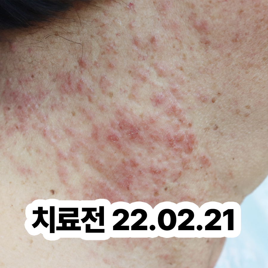 경기광주 사타구니 습진 병원 추천 관련 이미지 2