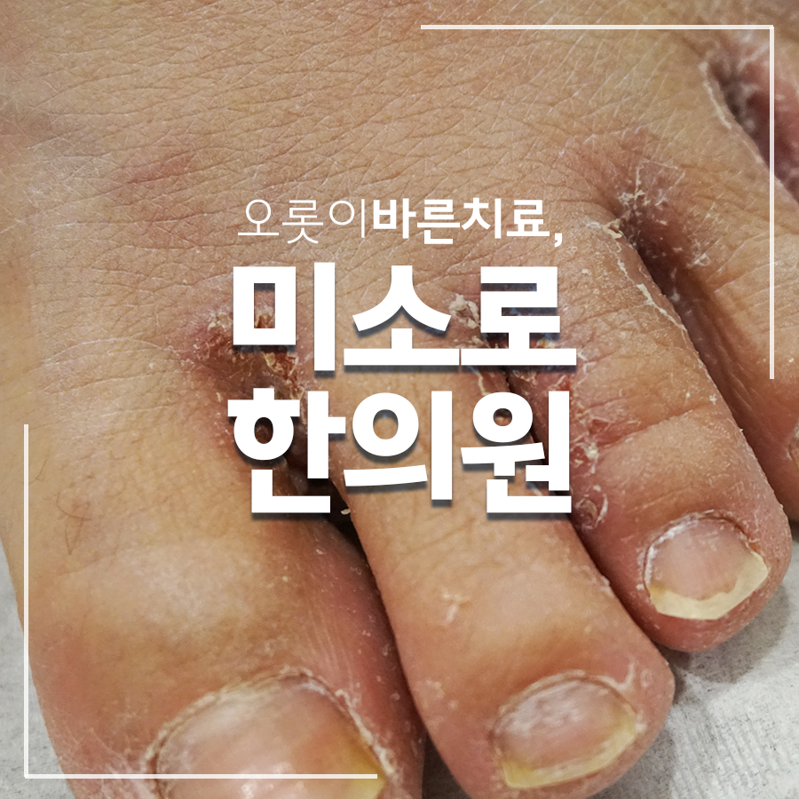 분당 한포진 한의원 실비 관련 이미지 1