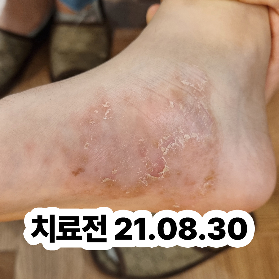 분당 발바닥 한포진 연고 추천 관련 이미지 2