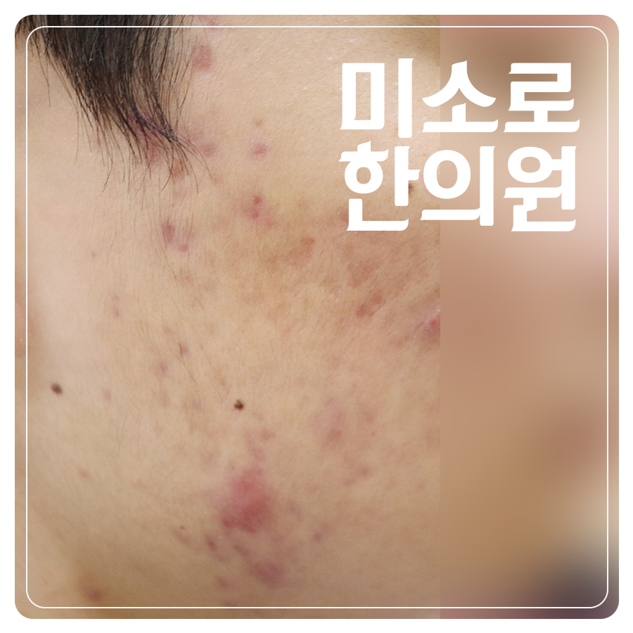 판교 화폐상습진치료 과정 관련 이미지 1