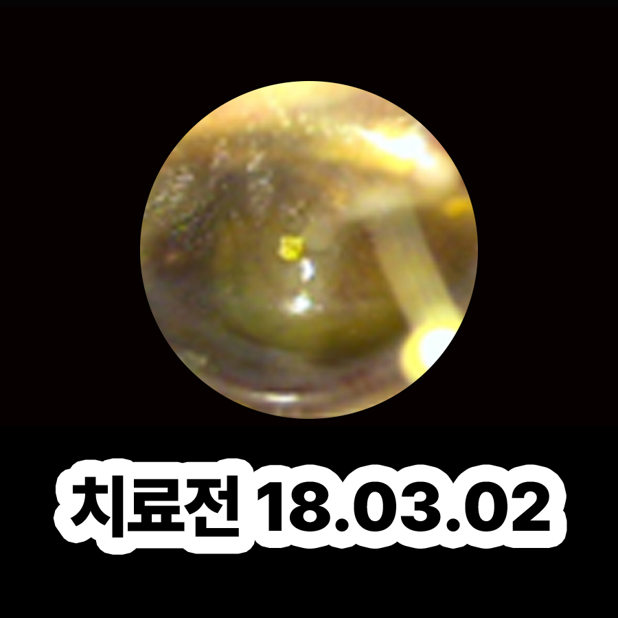 분당 만성 중이염 치료 기간 관련 이미지 2