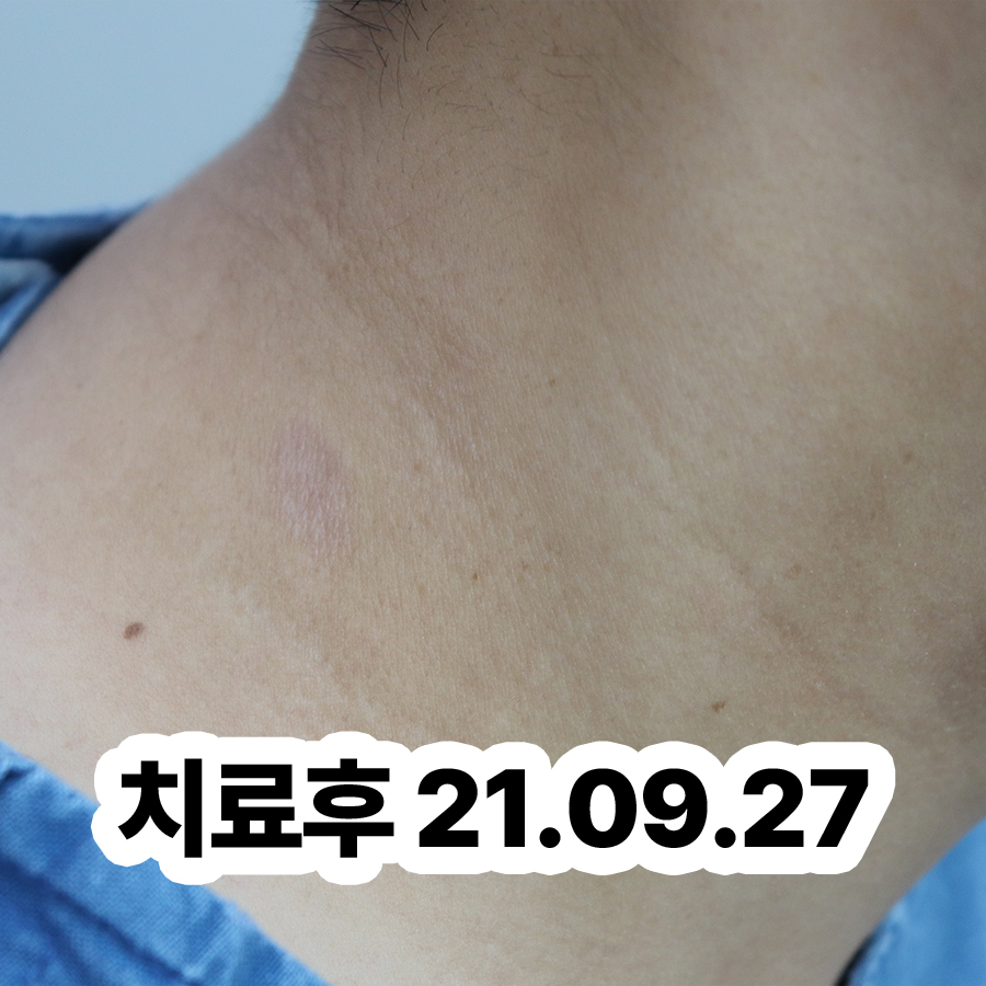 분당 아토피 한방치료 효과 관련 이미지 3