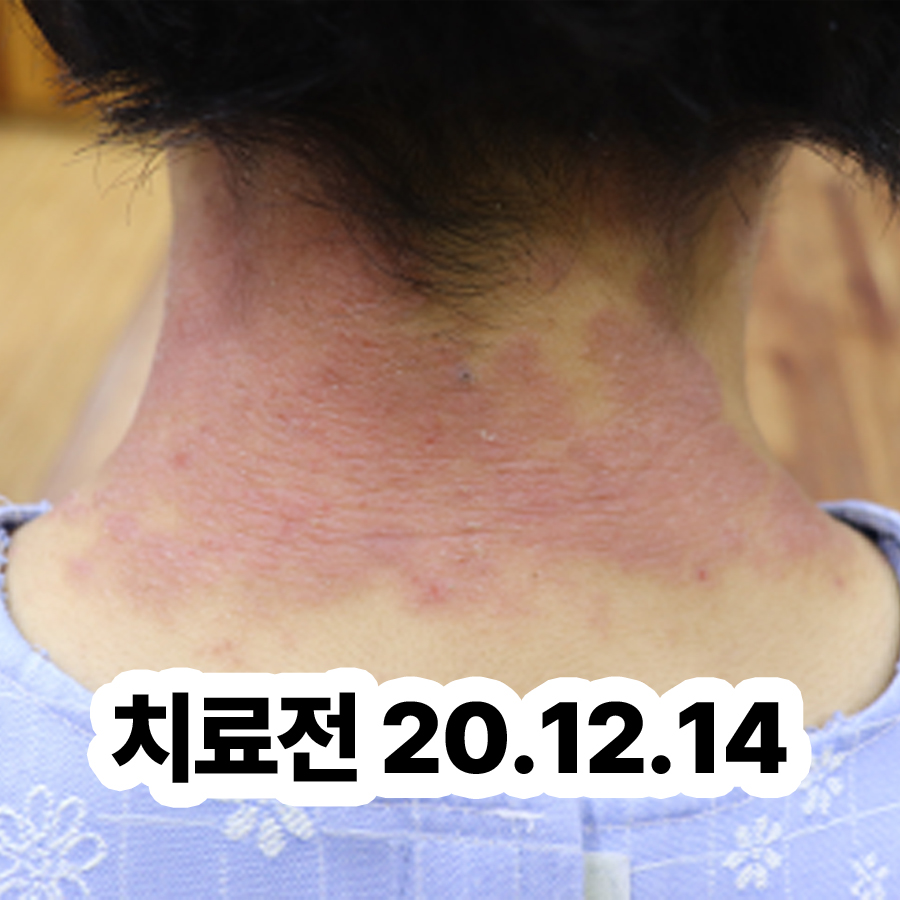 분당 성인아토피치료방법 관련 이미지 2