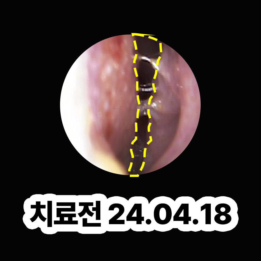 분당 비염치료잘하는병원 관련 이미지 2