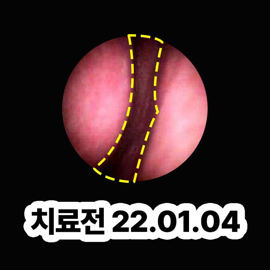 분당 비염 이비인후과 관련 이미지 2