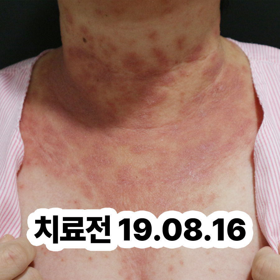 여주 아토피 치료 병원 관련 이미지 2