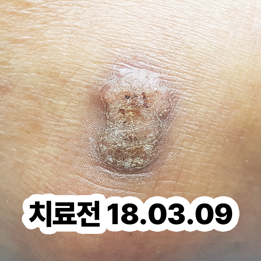 분당 사마귀 병원 관련 이미지 2