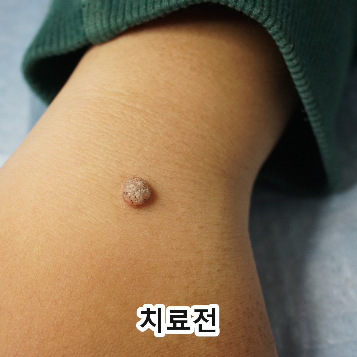 분당 손등 편평사마귀 살리실산 관련 이미지 2